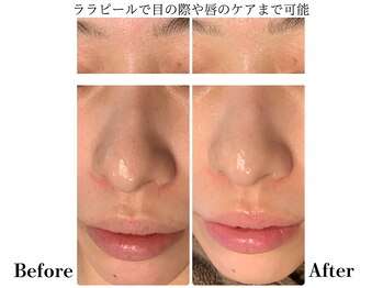 フレイヤ(FREYA)/ララピールBefore→After