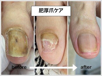 コバコ(kobaco)/肥厚爪ケア　1年間の成果比較