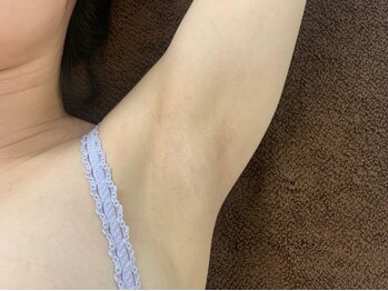 ニュアンスナイン(nuance9)の写真/【脱毛デビュー応援♪】痛みが少なく施術時間も短い！美肌効果◎丁寧なカウンセリングで初めてでも安心★