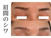 エトレ(etre)/ラミネーションピーリング/毛穴