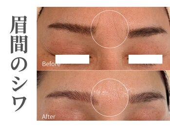 エトレ(etre)/ラミネーションピーリング/毛穴