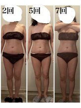 エムフルール 吹田市/痩身before/after