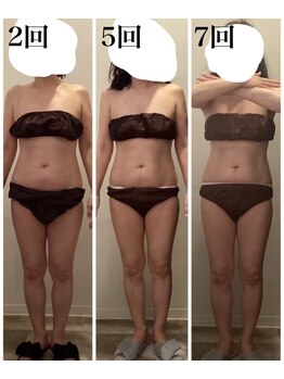 エムフルール 吹田市/痩身before/after