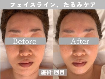 ミピマム 町田店/たるみケア、輪郭スッキリ！