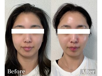 ラナ(Lana)/造顔！小顔矯正