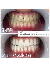 ホワイトニングサロン 京都烏丸店/ホワイトニング施術例