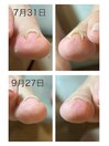 ネイルサロンで巻き爪ケア！