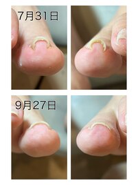 ネイルサロンで巻き爪ケア！
