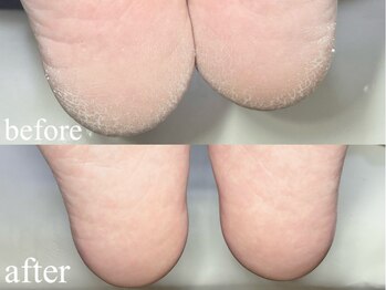 グランジーナ(Gran Jiina)/フット角質ケア