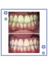 歯のホワイトニング専門店/【浦安】ホワイトニング