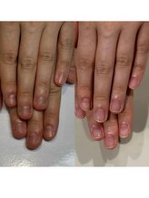 ティアラネイル 宇都宮/深爪矯正