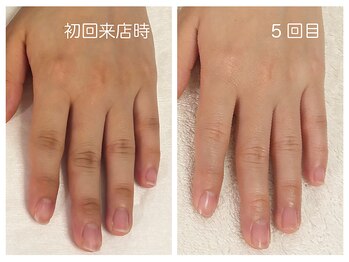 キレイテ 福岡天神店/40代/5回目【天神ハンドケア】