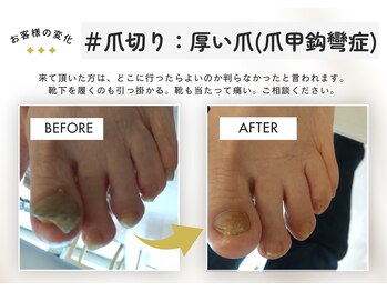 テネシー/#爪切り:厚い爪(爪甲鈎彎)