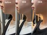 【最新！切らないリフトアップ】一回の施術で二重顎、ほうれん線も解消。