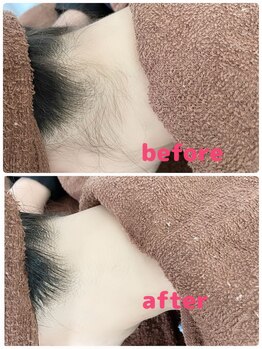 サロン シェリミー(Cheri mi)/うなじ脱毛