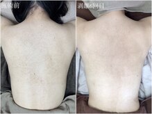 エミルカ(EMILUCA)/剥離ありハーブピーリングの効果