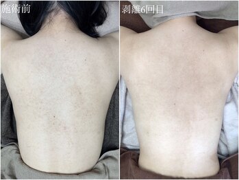 エミルカ(EMILUCA)/剥離ありハーブピーリングの効果