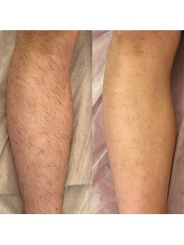 マハロ(MAHALO)/メンズ脱毛