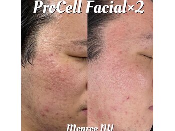 叶(Kanau)/【プロセルセラピーズ肌質改善】