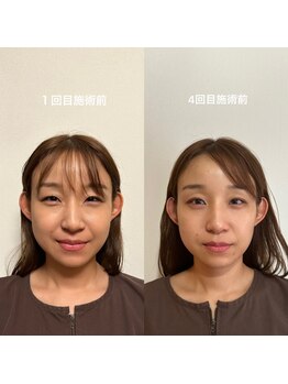 サス(SASU)/ルート鬼美容鍼3回/1ヶ月後