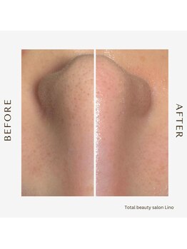 リノ(Lino)/BeforeAfter