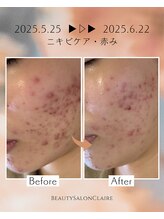 クレール(Claire)/【イラストリアス】ニキビケア