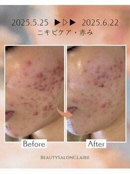 クレール(Claire)/【イラストリアス】ニキビケア