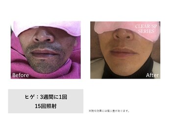 ラレピア(LA LEPIA)/お客様BeforeAfter☆
