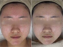 アンリミット 原宿竹下通り店(Une limit)/【赤みが悩む方へ】