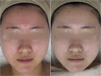 アンリミット 原宿竹下通り店(Une limit)/【赤みが悩む方へ】