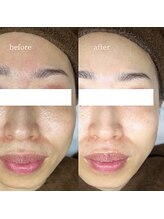 アーネスト 大阪心斎橋店(EARNEST)/泡＋水光【 肌乾燥・シワ 】