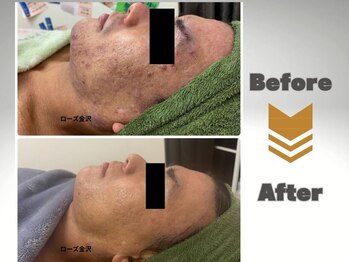 メディカルエステサロン ローズ 金沢本店(ROSE)/ニキビケア