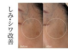 エトレ(etre)/ラミネーションピーリング/しわ