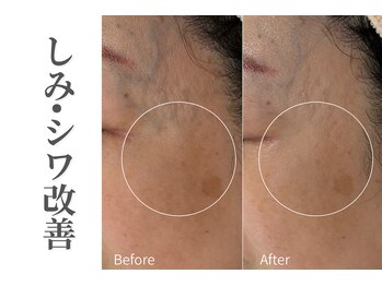 エトレ(etre)/ラミネーションピーリング/しわ