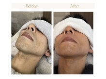 ラナンス 千早(LANUNCE)/ヒゲ脱毛　