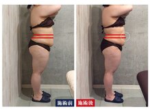 セシオ(SEACIO)/お腹スッキリ！(お腹施術3回)