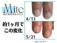 ミテ(Mite)/自爪育成/深爪美爪/福岡東区香椎