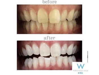 ホワイトニングショップ 新潟店/ホワイトニングビフォーアフター