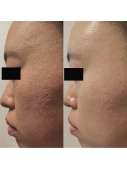 ホワイトアクア 天王寺本店(WHITE AQUA)/ハーブピーリング/大阪/天王寺