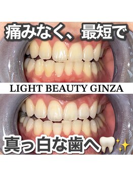 ライトビューティー 銀座店(LightBeauty)/東銀座　ホワイトニング症例写真