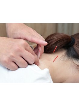 鍼灸施術を受けたい