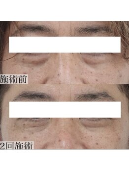 ヴェルシック(Belchic)/自力では改善できない目の下