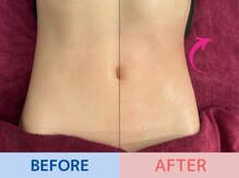 エル 麻布十番(LllL)/お腹周り痩せ【インディバ】