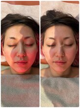 いこい鍼灸院 整骨院 小倉院/美容鍼でリフトアップ小顔