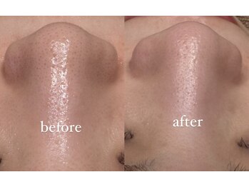 ラヴィン なんばスカイオ店(Lovin)/【うるツヤ肌毛穴ケアコース】