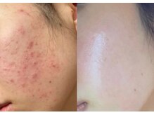 ラプア(Lapua)/渡韓無しで韓国水光肌ピーリング