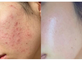 ラプア(Lapua)/渡韓無しで韓国水光肌ピーリング