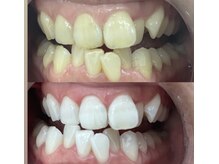 ホワイト 福岡天神店(WHITE)/６ヶ月継続ビフォーアフター