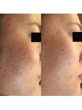 ホワイトアクア 天王寺本店(WHITE AQUA)/ハーブピーリング/大阪/天王寺