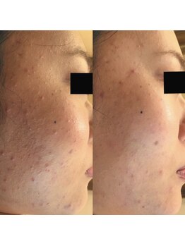 ホワイトアクア 天王寺本店(WHITE AQUA)/ハーブピーリング/大阪/天王寺